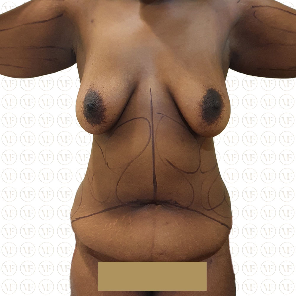 Mummy Makeover - TT Lipo Breastlift - Vitality Fountain Clinic