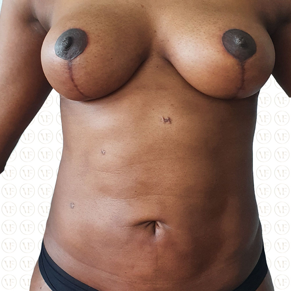 Breast lift and 360 Lipo Vitality Fountain Clinic