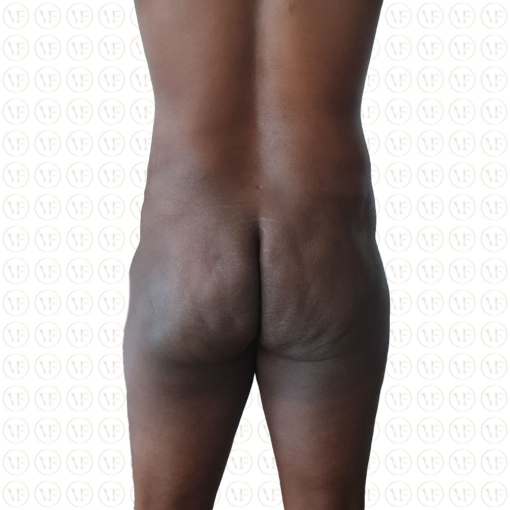 Liposuction Male Buttocks - Vitality Fountain Clinic