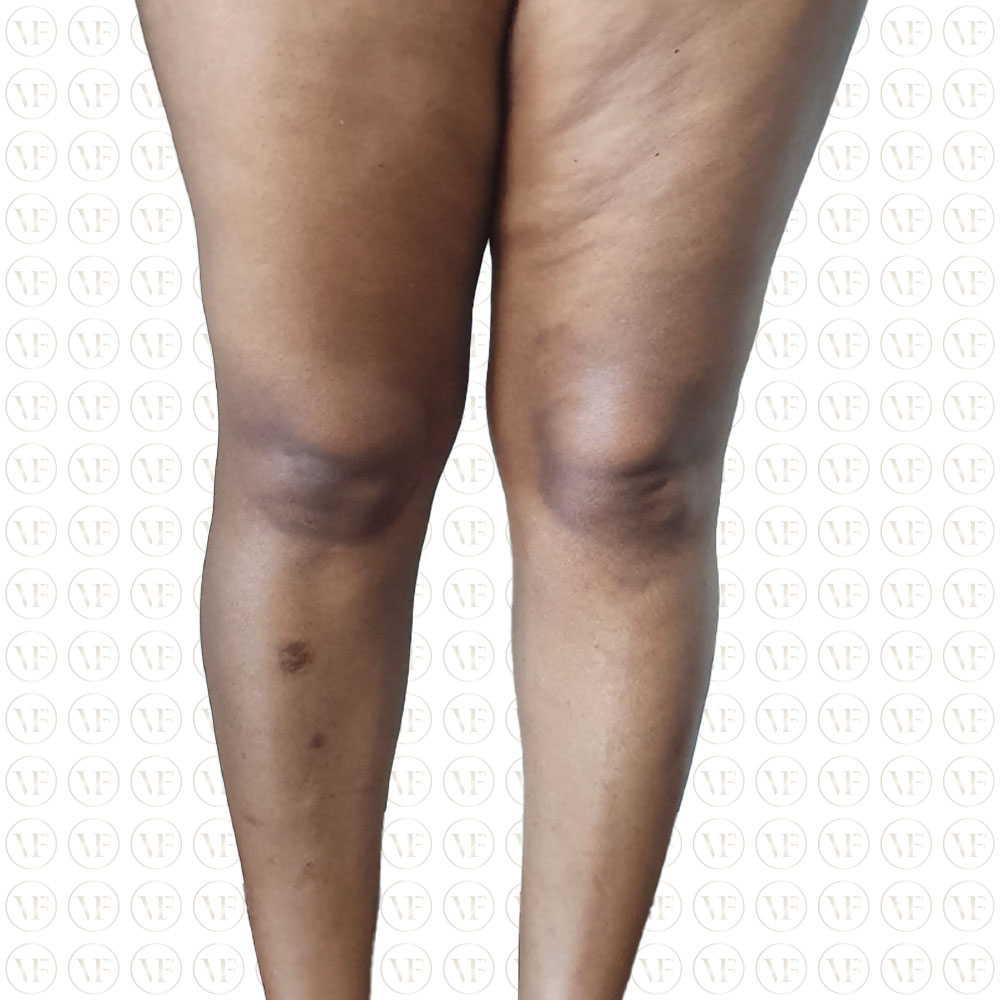 Fatgrafting legs - Vitality Fountain Clinic
