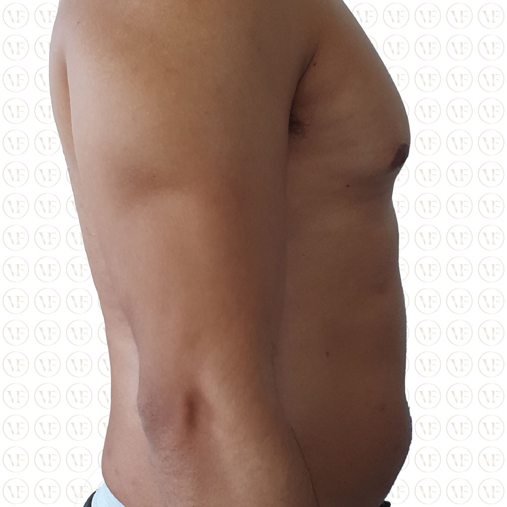 Liposutction-Six-pack-Male - Vitality Fountain Clinic