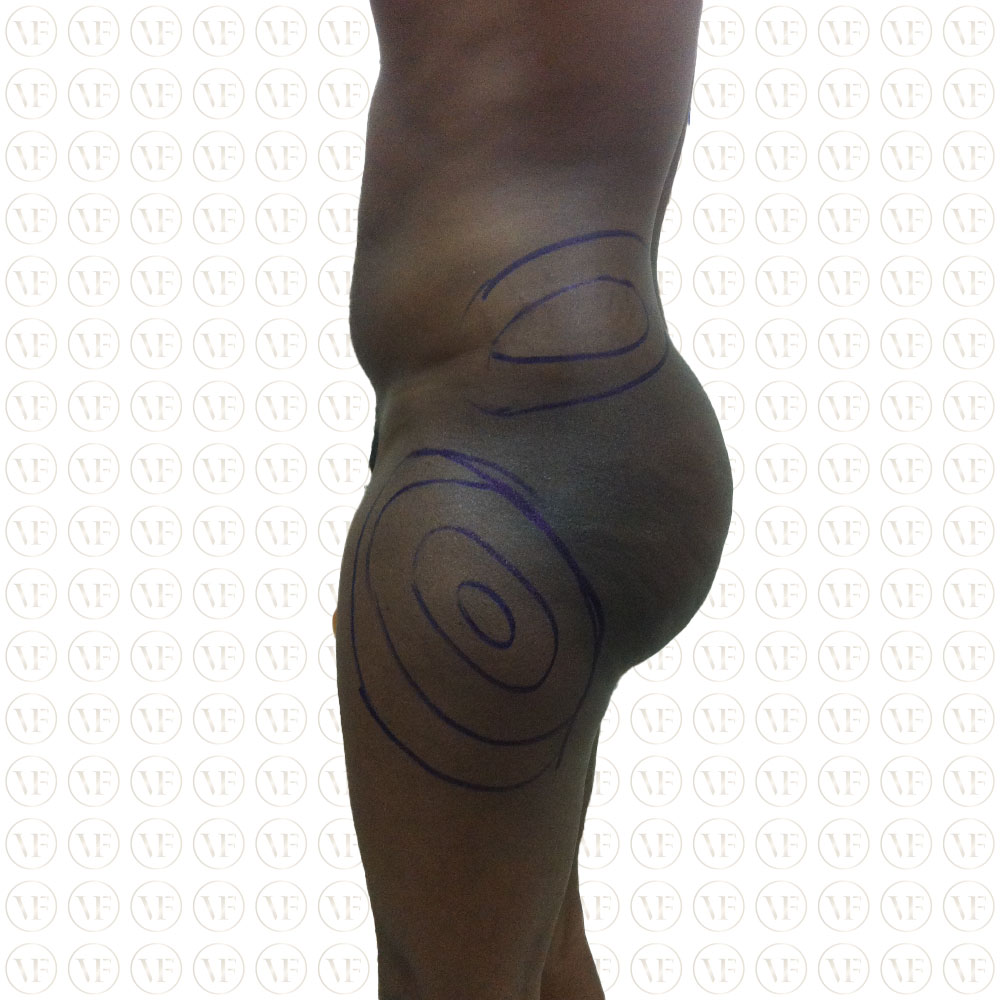 Liposuction Male Buttocks - Vitality Fountain Clinic